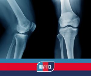 Read more about the article ADVANCE bolt-on study: Biomarkers and Joint Pain in Military Osteoarthritis (Bio-Mil-OA)